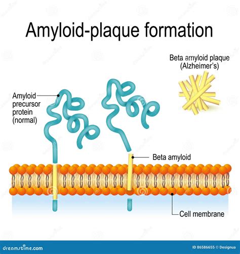 amyloid beta plaque